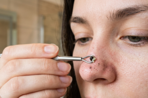 blackhead remover